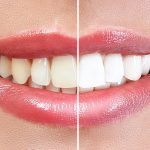 Zoom Whitening Dentist Central HK